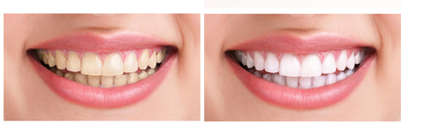 Відбілювання зубів Beyound, система Polus