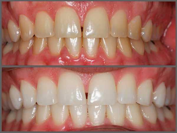 Лазерне відбілювання зубів в клініці: вартість в стоматології, плюси і мінуси, скільки коштує та чи шкідливо відбілювати лазером, фото