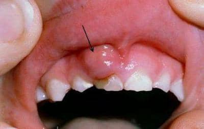 Болить зуб, опухла десна біля нього: ниючий зубний біль