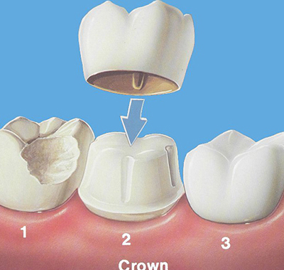 Що краще: коронка або імплант, їх встановлення та імплантація, на які зуби варто ставити, як вони кріпляться