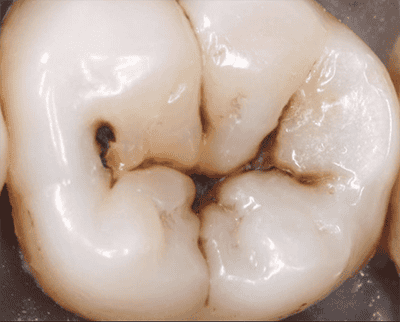 Карієс всередині зуба: причини внутрішнього запалення, як лікувати зсередини