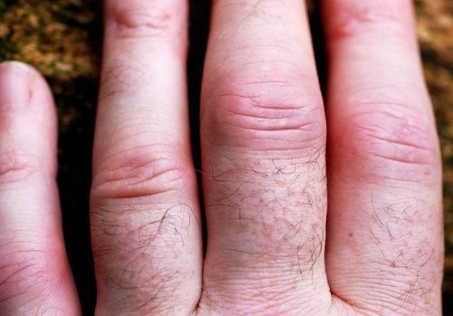 Ревматоїдний артрит: що це за хвороба?
