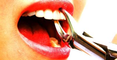 Як видалити зуб в домашніх умовах без болю у дорослого
