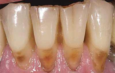 Прикореневій карієс: лікування передніх зубів, що робити, як лікують