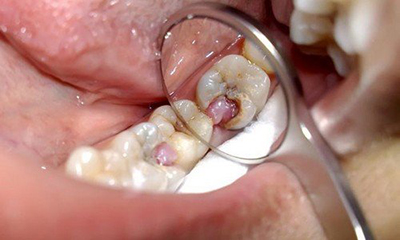 Пульпіт: лікування у дітей, що це таке, біологічні методи, як лікувати у дитини постійні зуби з несформованими коренями