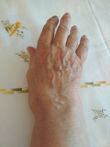 Ревматоїдний артрит: що це за хвороба?