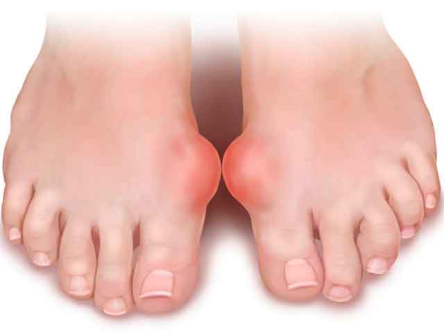 Лікування кісточок на ногах народними засобами