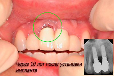 Видалення імпланта зуба: чи можна і як видалити, а також які наслідки?