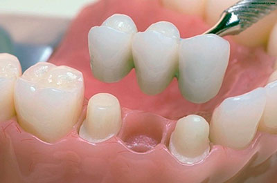 Імплант або міст: що краще поставити на жувальний зуб, мостовидний зубний протез