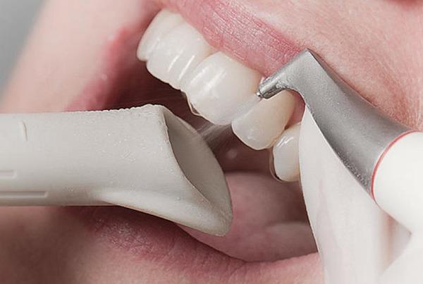 Чистка перед брекетами: що потрібно знати та зробити перед установкою, підготовка до процесу, що роблять з зубами під час процедури