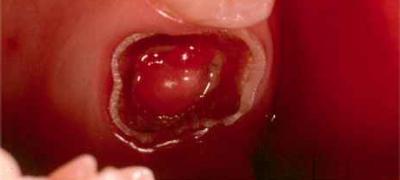 Гострий пульпіт зуба, хронічний виразковий: лікування, МКБ 10, симптоми, клініка, диферен діагностика, скарги, пульсуючий характер болю
