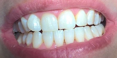 Відбілювання зубів Amazing White: система Амазинг вайт