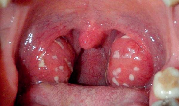 Стоматити на горлі і на гландах: лікування у дорослих, фото мигдалин, як і чим лікувати, може бути таке в гортані, від чого болить
