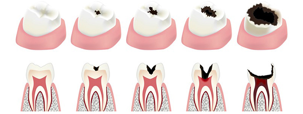 Етапи лікування карієсу зубів, опис алгоритму поетапно