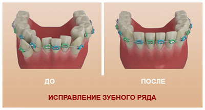 Біль в зубах при брекетах і після, що робити, якщо болять, як прибрати і полегшити, зубне знеболювальне при носінні