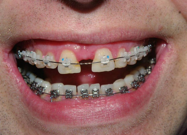Скільки носять брекети, терміни носіння при лікуванні, як довго потрібно ходити дорослій людині, щоб вирівняти зуби, фото до і після