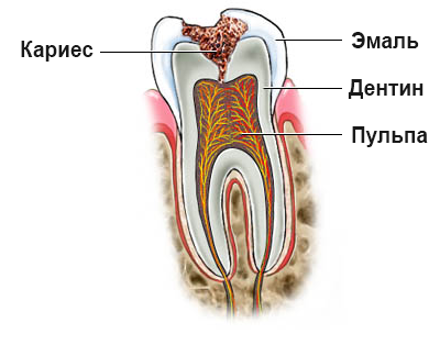 Середній карієс і глибокий за МКБ 10, диференціальна діагностика зубів, EDI, скарги, клінічний перебіг, симптоми, що це таке?