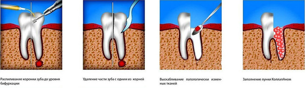 Методи лікування періодонтиту: зубозберігаючі консервативно хірургічні операції, сучасні лазери, пломбування каналів
