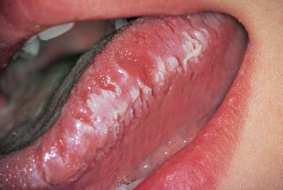Стоматит у дорослих мовою фото: як вилікувати на кінчику або корені, як лікувати виразки у роті швидко, лікування і симптоми