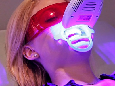 Апарат для відбілювання зубів: які інструменти застосовують у сучасній апаратної стоматології для освітлення емалі