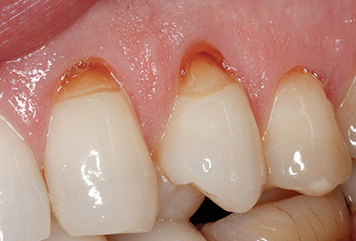 Пришеечный карієс під яснами: придесневій біля основи шийки зуба мудрості, стадії, профілактика шийкового, зубна паста, симптоми