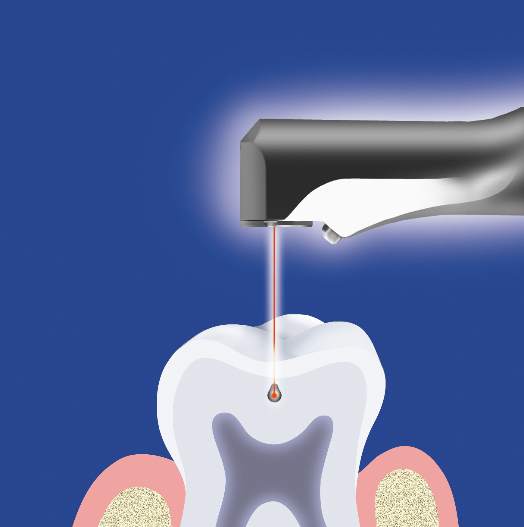 Эндоотбеливание зубів – естетичний метод відбілювання зубів