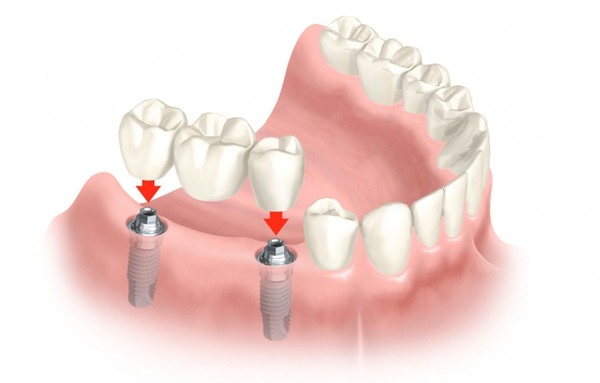 Протезування зубів при відсутності зубів верхньої щелепи: повна імплантація без кісткової тканини, нижні міні протези на імплантатах