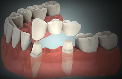 Імплант або міст: що краще поставити на жувальний зуб, мостовидний зубний протез