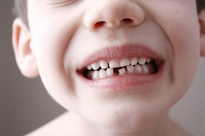 Молочний прикус: що це таке, скільки зубів у ранньому змінному прикусі, формула тимчасових у дітей, зубна таблиця