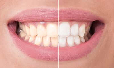 Як відбілити зуби за допомогою фольги алюмінієвої: способи відбілювання