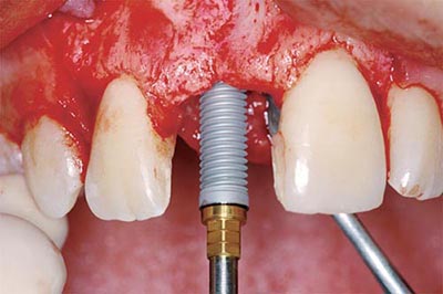 Видалення імпланта зуба: чи можна і як видалити, а також які наслідки?