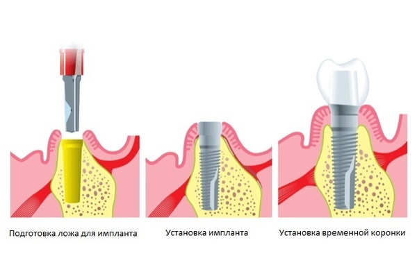 Імплантація нижніх зубів жувальних: який імплант і протез краще поставити на щелепу, небезпечно ставити етапи протезування