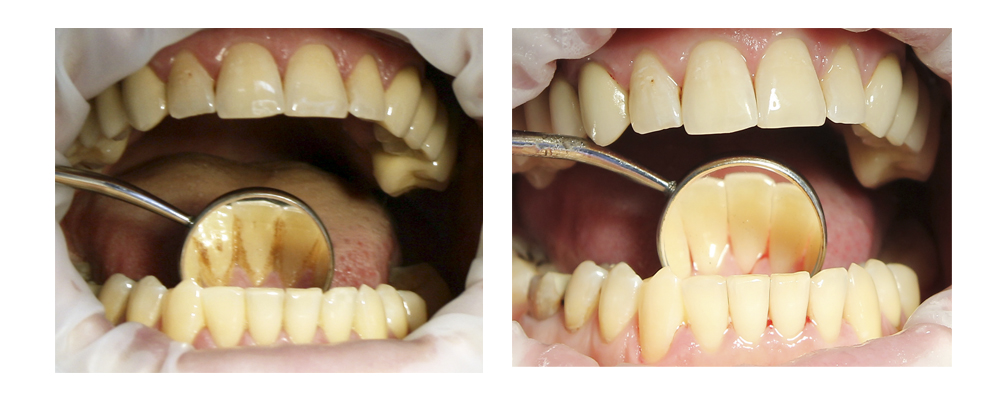 Відбілювання зубів ультразвуком, переваги та недоліки методу