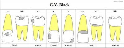 Класифікація карієсу по Блеку, які існують класи патології