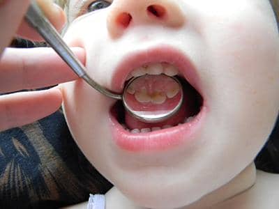 Лікування карієсу у дітей, як лікують у постійних дитячих зубів, особливості поверхневого, середнього і глибокого