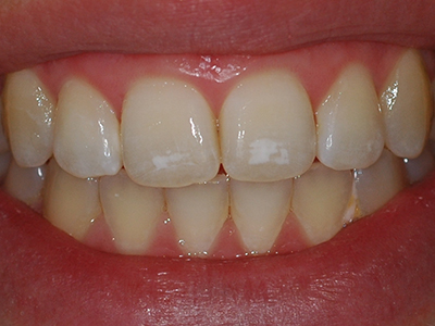 Відбілювання зубів: наслідки, небезпечні ускладнення, чутливість, плями, догляд після процедури, що робити, якщо стріляють