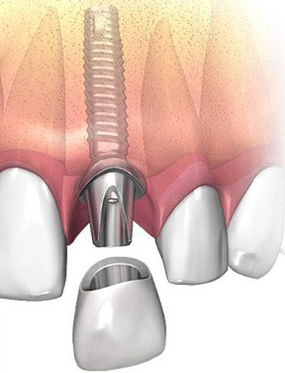 Протезування зубів на імплантатах і без, види зубних протезів: мостоподібний і балковий, плюси і мінуси, чим відрізняється імплантація