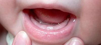 Стоматит у дитини: фото в роті і на щоках, як лікувати дітей в домашніх умовах, що робити при симптомах, лікування температури