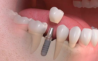Дентальна імплантація: планування операції з внутрішньокісткової системі зубів, показання та протипоказання