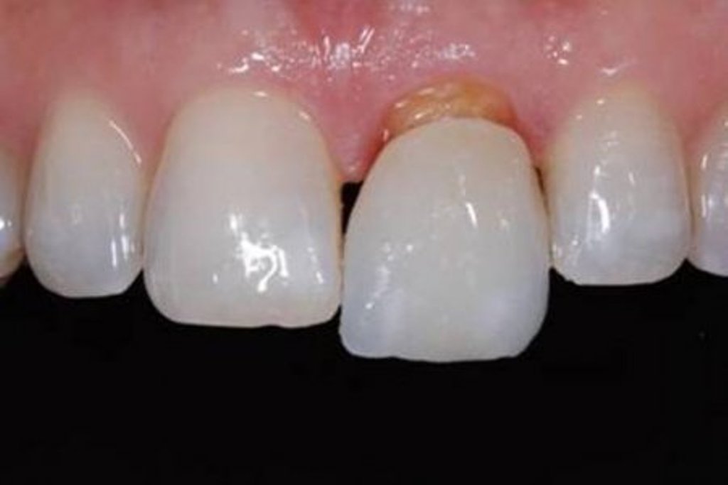 Карієс передніх зубів. Лікування і профілактика карієсу передніх зубів.