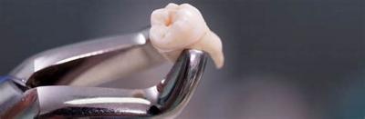 Стоматит після видалення зуба мудрості: чи можна лікувати при прорізуванні, зубна паста від стоматолога, щоб чистити у роті