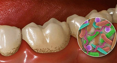 Запущений карієс: наслідки та лікування зуба, що робити, якщо вже сильний і великий вогнище ураження