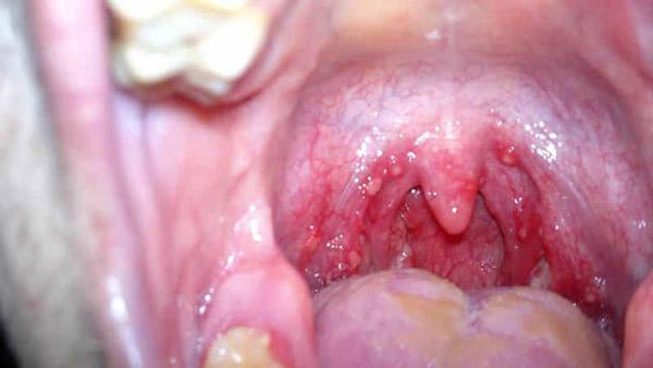 Стоматит у дитини: фото в роті і на щоках, як лікувати дітей в домашніх умовах, що робити при симптомах, лікування температури