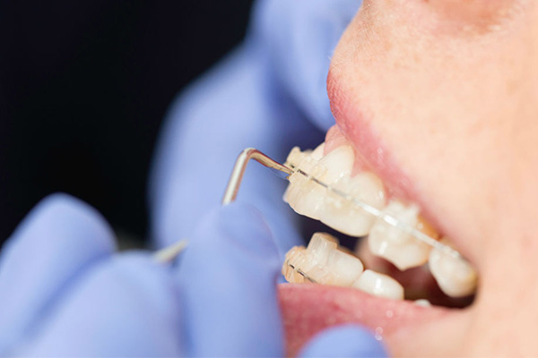 Скільки болять зуби після установки брекетів, коли починають і як довго буде тривати біль, що робити, чи боляче носити два дні