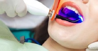 Апарат для відбілювання зубів: які інструменти застосовують у сучасній апаратної стоматології для освітлення емалі