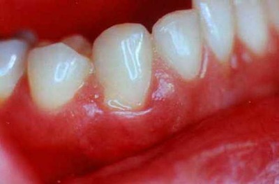 Протипоказання до імплантації зубів, можливі ускладнення для установки зубних імплантантів при пародонтозі, цукровому діабеті, ВІЛ