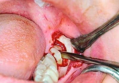 Видалення зламаного зуба мудрості під яснами, як видаляють якщо зламався під корінь і чому важливо видалити