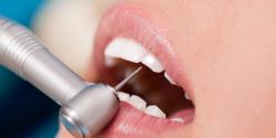 Народні способи відбілювання зубів, різновиди відбілювання зубів будинку