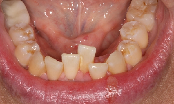 Брекети на нижню щелепу: чи можна поставити тільки одну, фото зубів до і після установки керамічних, навіщо ставити системи