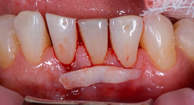 Нарощування кісткової тканини при імплантації зубів, як відбувається пластику ясен при зубному операції, як ставлять імплант на кістку